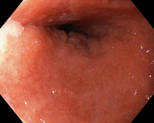 пищевод Барретта