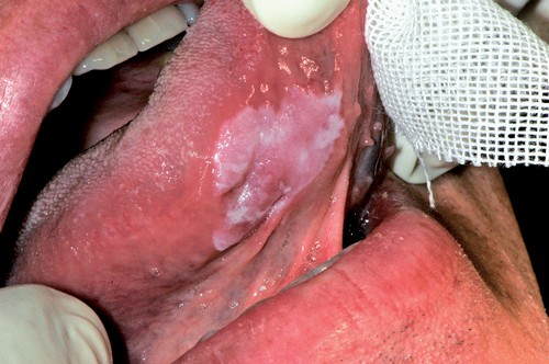 Вирусный стоматит