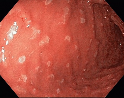 Хронический антральный гастрит