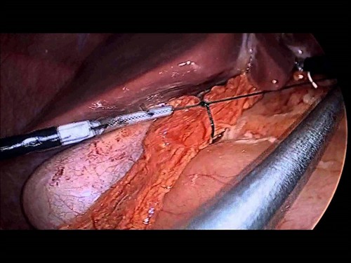 Перфорация язвы желудка