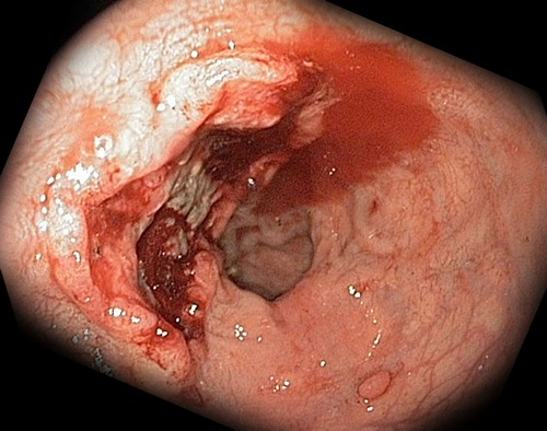 Кровоточащая язва желудка