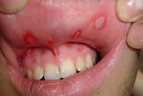 Как выглядит грибковый стоматит
