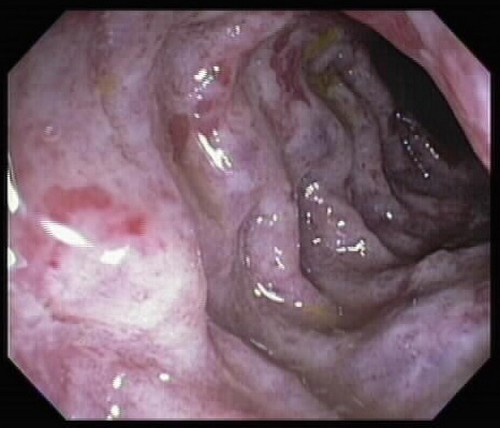 Неспецифический колит - как выглядит