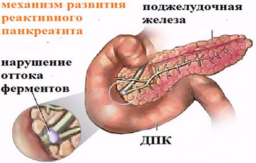 Лечение панкреатита у взрослых