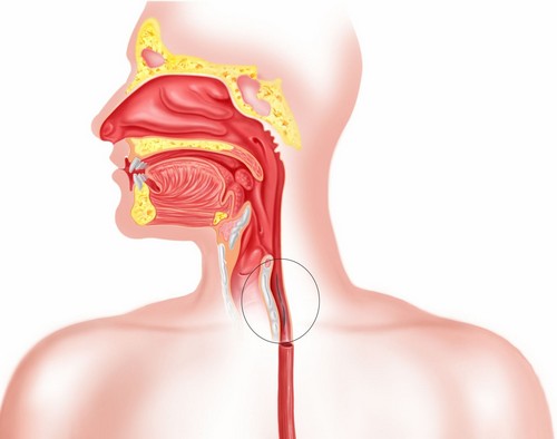 Как выглядит рефлюкс-эзофагит