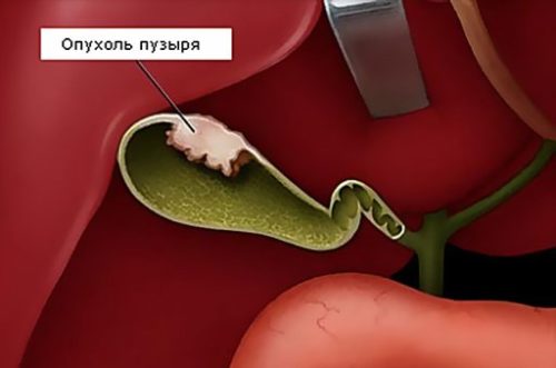 Опухоль желчного пузыря