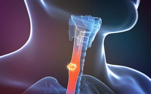 Симптоматика рака пищевода и возможные методы лечения