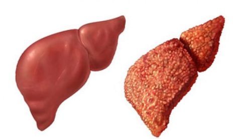 Диффузные изменения печени