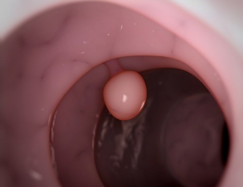 Полип пищевода