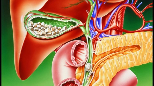 Камни поджелудочной железы – опасность заболевания