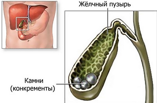Осложнения при застое желчи