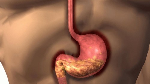 Атрофический дуоденит – причины, провоцирующие факторы, симптомы, лечение