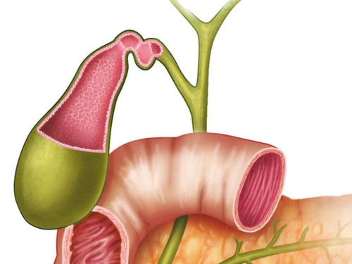 Перегиб шейки желчного пузыря