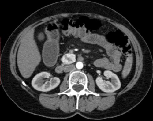 КТ поджелудочной железы