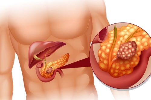 Метастазы в поджелудочной железе