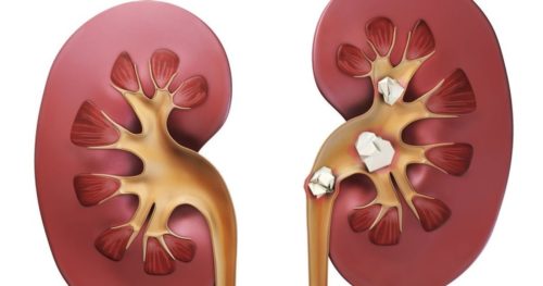 Камни почек